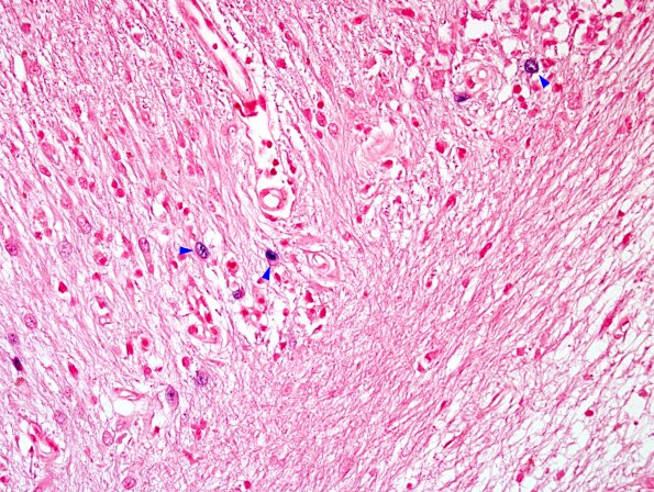 1H2 Granule cell neuronopathy (Case 1 Autopsy specimen) N14 JCV ISH 6 copy