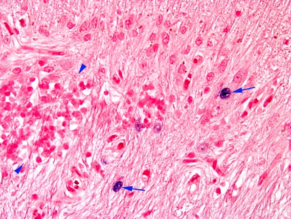 1H6 Granule cell neuronopathy (Case 1 Autopsy specimen) N14 ISH 22 copy