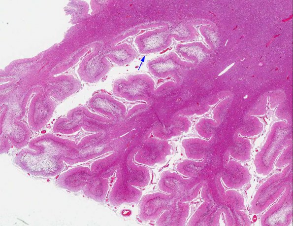 2A1 PML with Granule cell loss (AANP 1993, Case 7) H&E X0