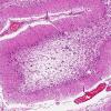 2A2 PML with Granule cell loss (AANP 1993, Case 7) H&E X6