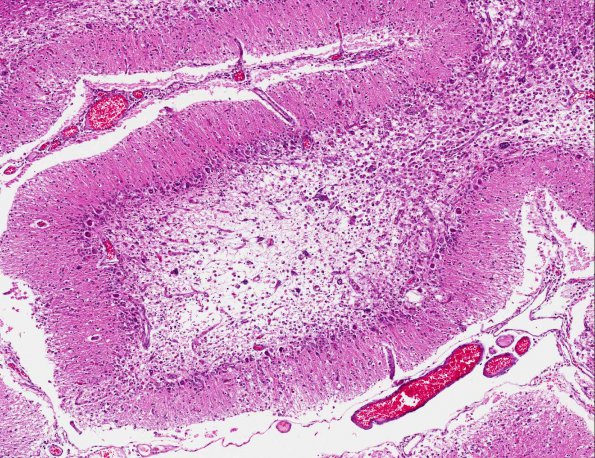 2A2 PML with Granule cell loss (AANP 1993, Case 7) H&E X6