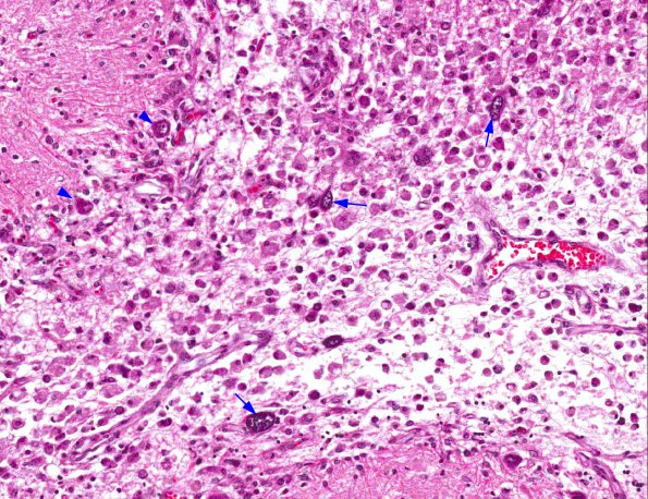 9A3 PML with Granule cell loss (AANP 1993, Case 7) H&E X20 2 copy