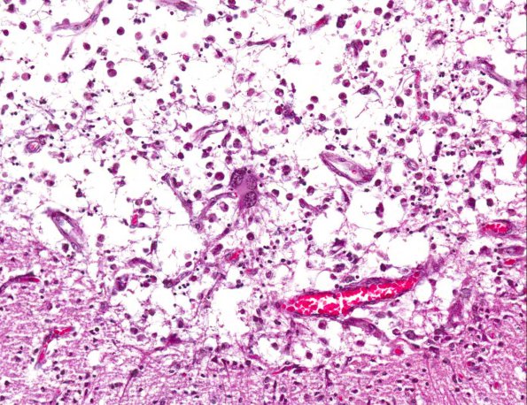 9A4 PML with Granule cell loss (AANP 1993, Case 7) H&E X20 3