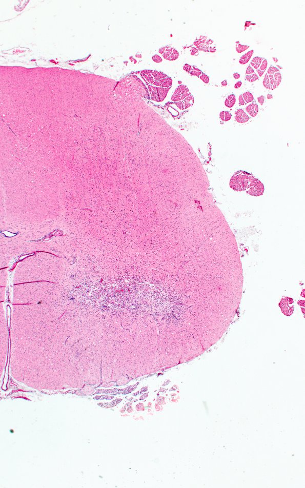 1B2 Poliomyelitis (Case 1) Slide 100 H&E 30