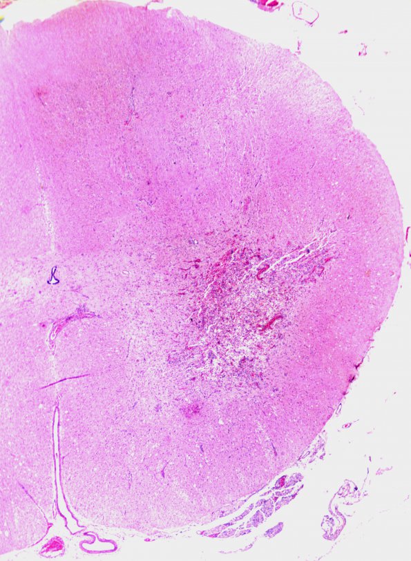 1B3 Poliomyelitis 2 (2) A