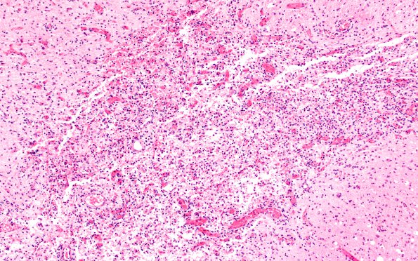 1B5 Poliomyelitis (Case 1) Slide 100 H&E 33