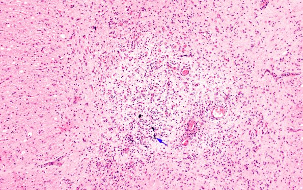 1B7 Poliomyelitis (Case 1) Slide 100 H&E 6 copy