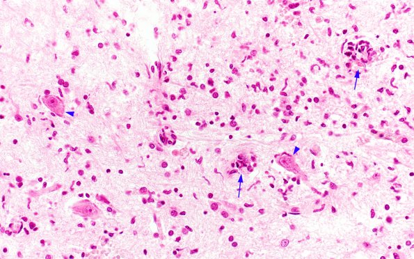 1B9 Poliomyelitis (Case 1) Slide 100 H&E 28 copy