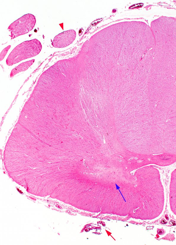 2B3 Polio, inactive, (Case 3) anterior horn H&E whole mount A copy copy