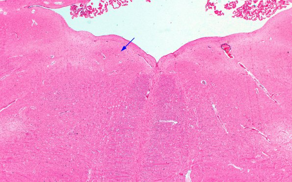 3A1 Polio, inactive, ts, medulla H&E 2X copy