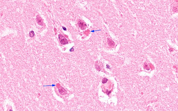 1A8 Rabies (AANP 1997-08) Hippocampus H&E 100X