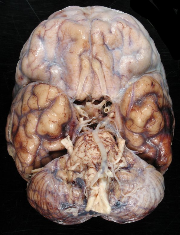 1A1 Rubella (Case 1) Hx Childhood Adult at death gross 6