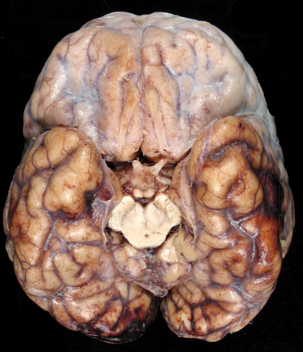 1A3 Rubella (Case 1) Hx Childhood Adult at death gross 7