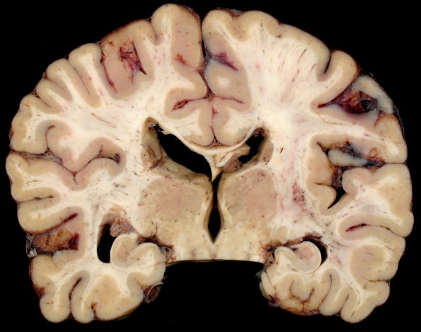 1E Rubella (Case 1) Hx Childhood Adult at death gross 3