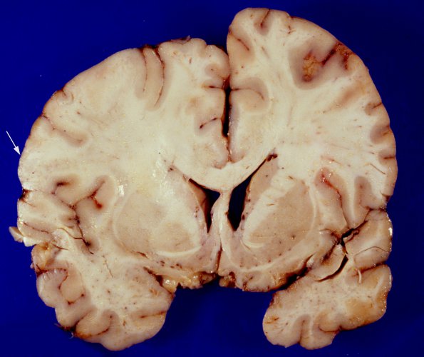 1A1 SSPE (Case 1) gross 1 copy