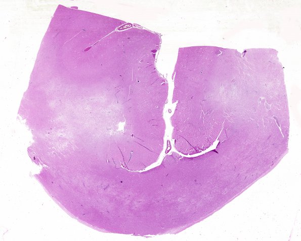 1B1 SSPE (Case 1) H&E whole mount