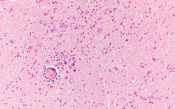 1A1 St Louis Encephalitis (Case 1) H&E 10