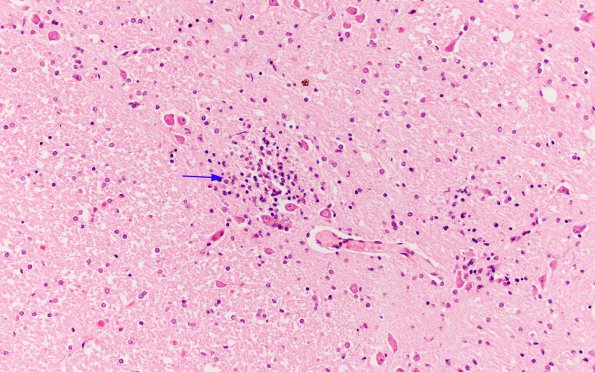 1A2 St Louis Encephalitis (Case 1) H&E 4 copy