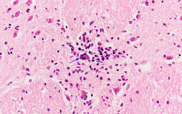 1A3 St Louis Encephalitis (Case 1) H&E 8 copy