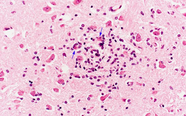 1A4 St Louis Encephalitis (Case 1) H&E 9 copy