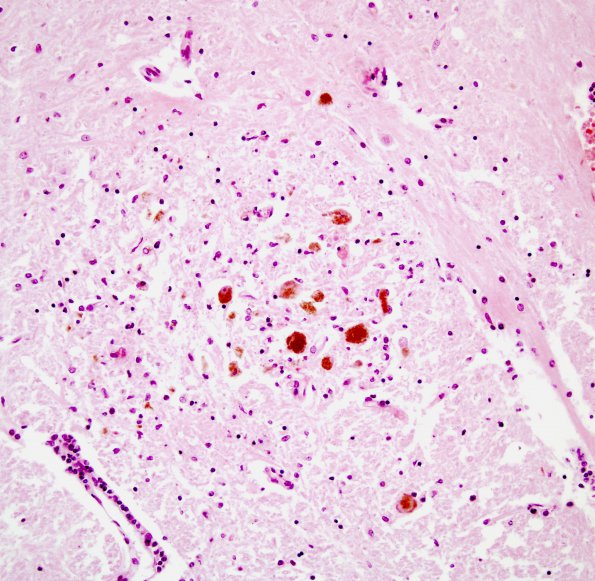 1A5 Saint Louis Encephalitis (Case 1) Midbrain 1A