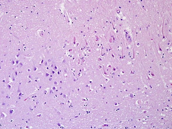 1A1 Encephalitis, West Nile (Case 1) H&E 20X