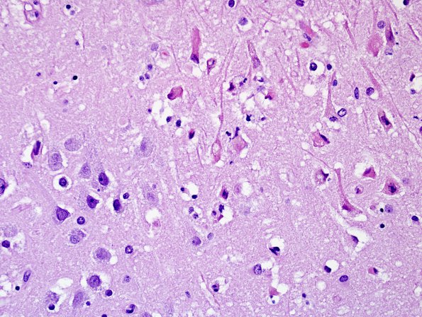 1A2 Encephalitis, West Nile (Case 1) H&E 40X 2