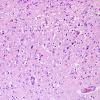 1A3 Encephalitis, West Nile (Case 1) H&E 20X 2