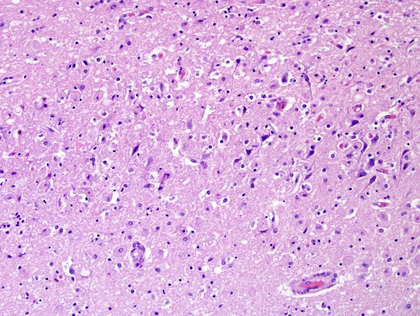 1A3 Encephalitis, West Nile (Case 1) H&E 20X 2