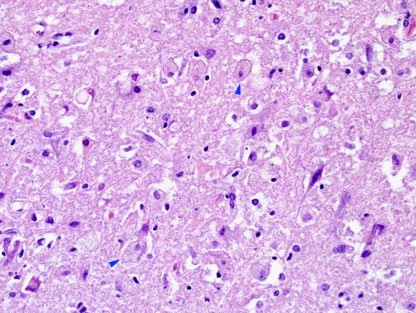 1A4 Encephalitis, West Nile (Case 1) H&E 40X copy