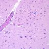 1A5 Encephalitis, west nile (Case 1) H&E 2 copy