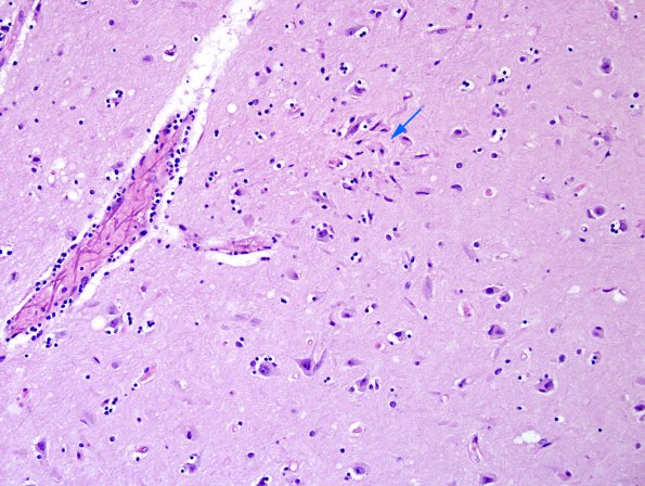 1A5 Encephalitis, west nile (Case 1) H&E 2 copy