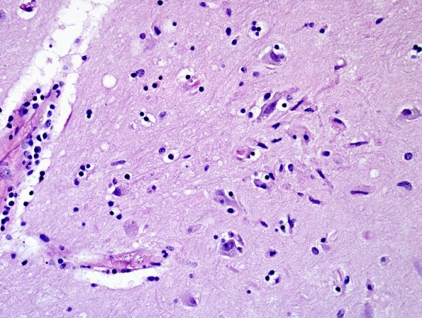 1A6 Encephalitis, west nile (Case 1) H&E 1