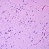 1B1 Encephalitis, west nile (Case 1) H&E 6