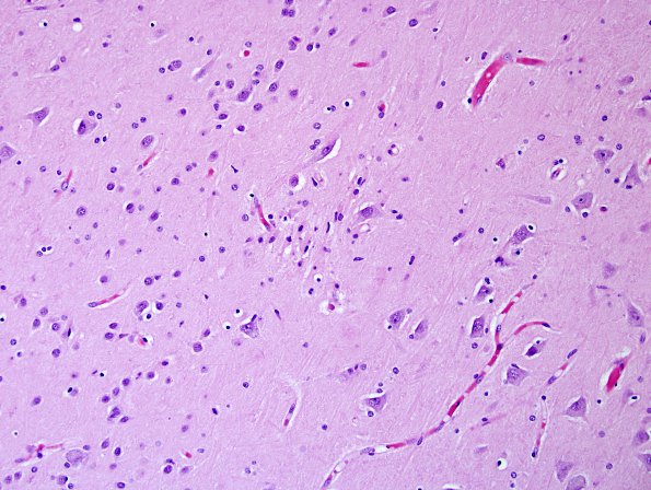 1B1 Encephalitis, west nile (Case 1) H&E 6