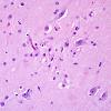 1B2 Encephalitis, west nile (Case 1) H&E 5