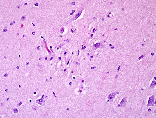 1B2 Encephalitis, west nile (Case 1) H&E 5