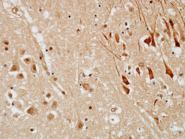 1C1 Encephalitis, West Nile (Case 1) Anti-WNV 40X