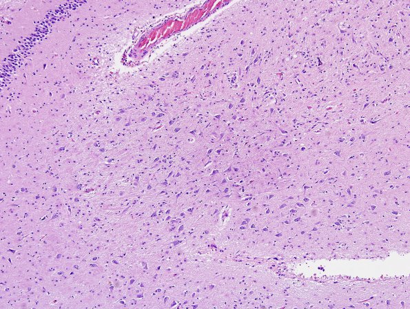 2A1 Encephalitis, west nile (Case 2) H&E 4