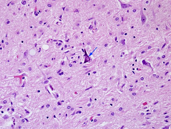 2A2 Encephalitis, west nile (Case 2) H&E 6 copy