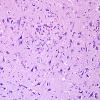 2B1 Encephalitis, west nile (Case 2) H&E 2