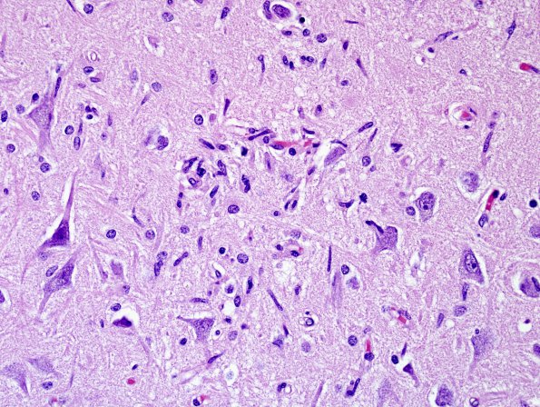 2B2 Encephalitis, west nile (Case 2) H&E 3