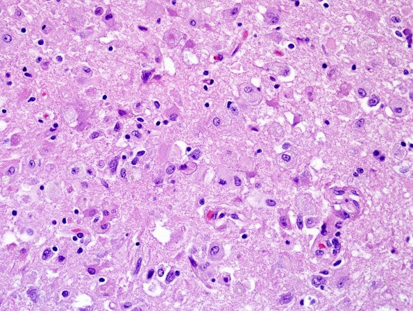 2B3 Encephalitis, west nile (Case 2) H&E 1