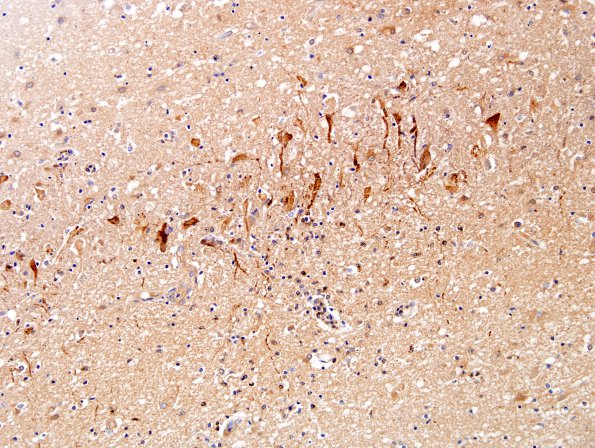 2C Encephalitis, West Nile (Case 2) Anti-WNV 20X