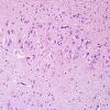 3A1 Encephalitis, west nile (Case 3) H&E 2