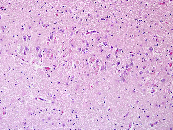 3A1 Encephalitis, west nile (Case 3) H&E 2