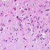 3A2 Encephalitis, west nile (Case 3) H&E 1