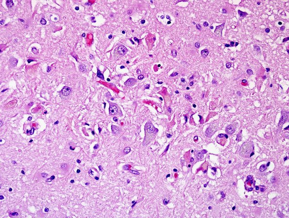 3A2 Encephalitis, west nile (Case 3) H&E 1