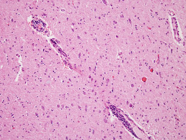 5A1 Encephalitis, West Nile (Case 5) H&E 6