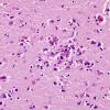 5A2 Encephalitis, West Nile (Case 5) H&E 8